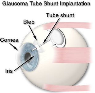 Glaucoma Tube Shunt Implantation Diagram