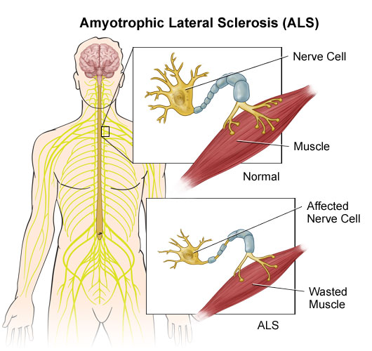 Diagram of Amyotrophic Lateral Sclerosis