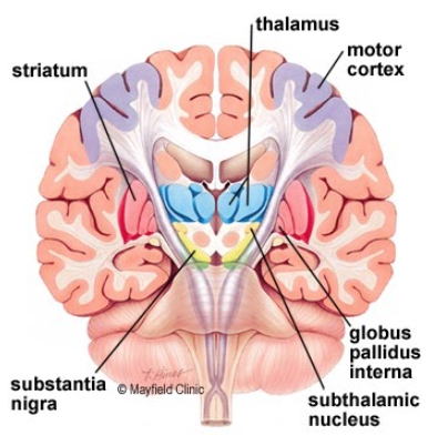 Illustration of Brain Parkinson's Disease